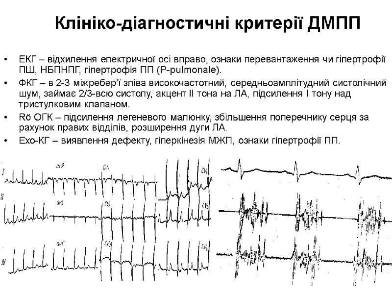 Клініко-діагностичні критерії ДМПП ЕКГ – відхилення електричної осі вправо, ознаки перевантаження чи гіпертрофії ПШ,